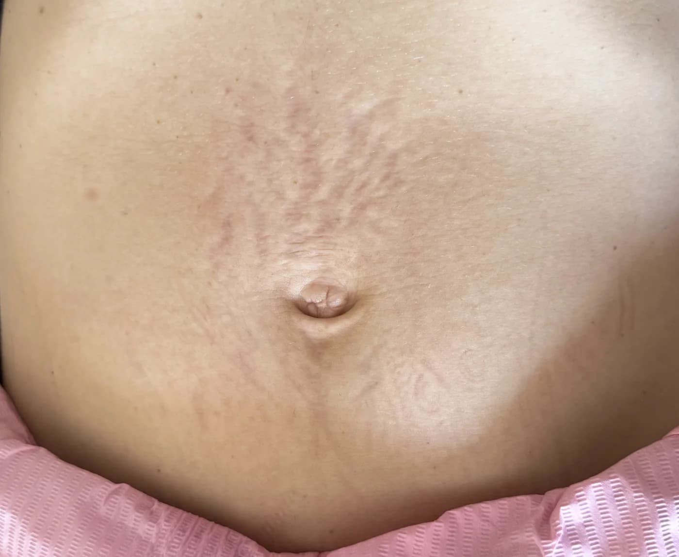 Micropuntura para estrías en Althea Estetic