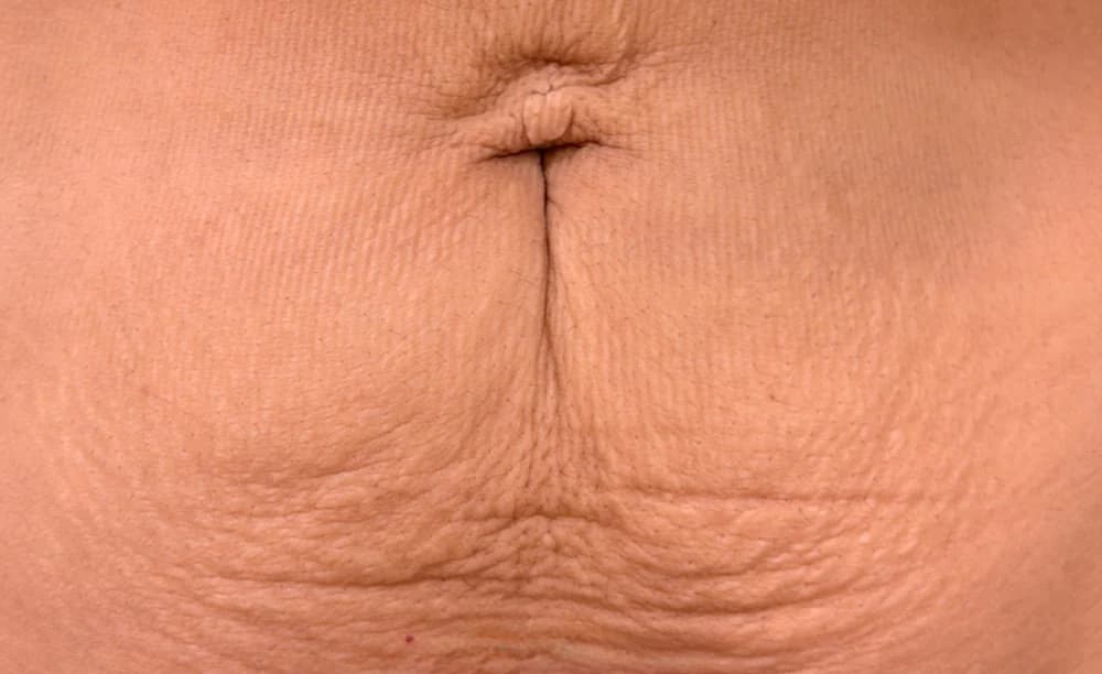 Flacidez abdominal, tratado con Fibroblast — antes