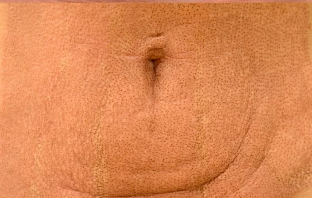 Flacidez abdominal, tratado con Fibroblast — después