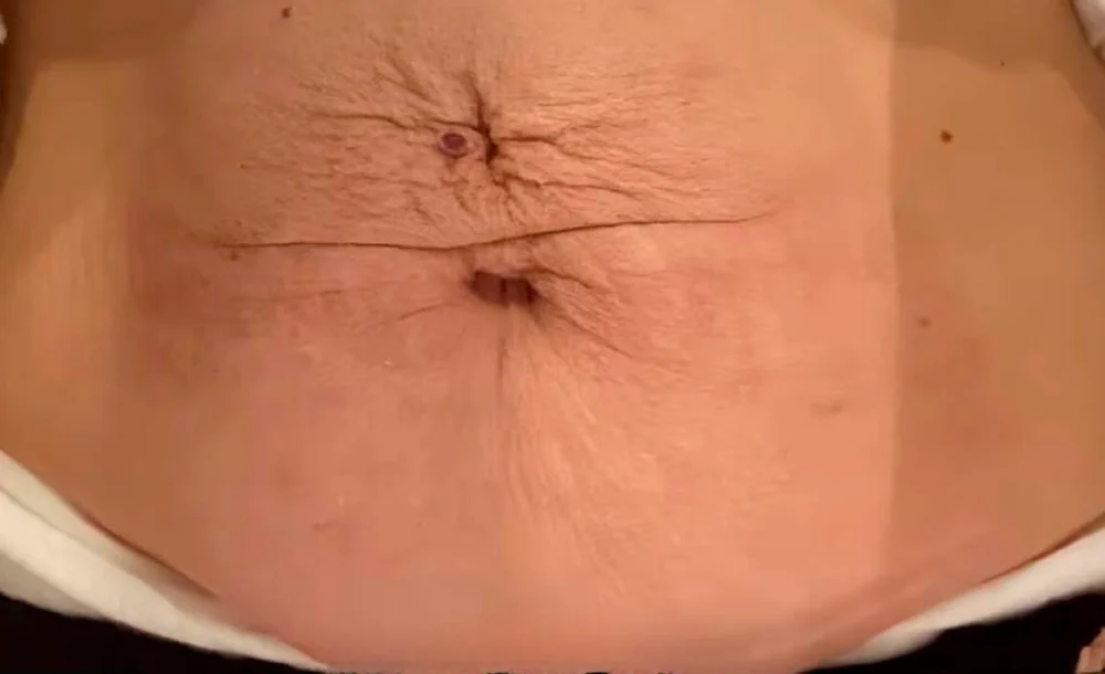 Flacidez abdominal, tratado con Fibroblast — antes
