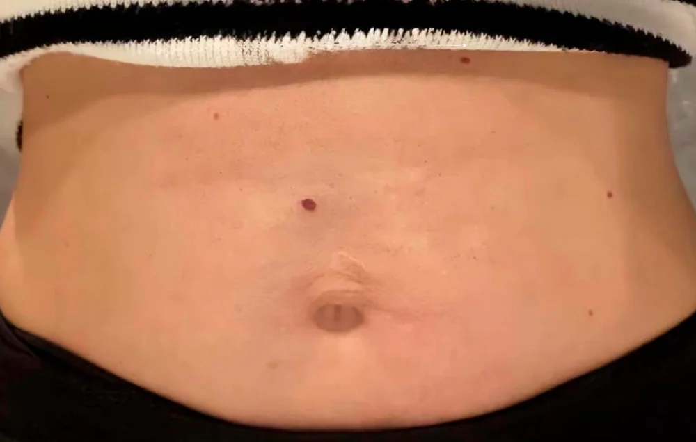 Flacidez abdominal, tratado con Fibroblast — después
