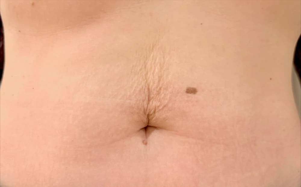 Flacidez abdominal, tratado con Fibroblast — antes