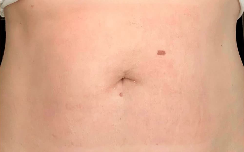 Flacidez abdominal, tratado con Fibroblast — después
