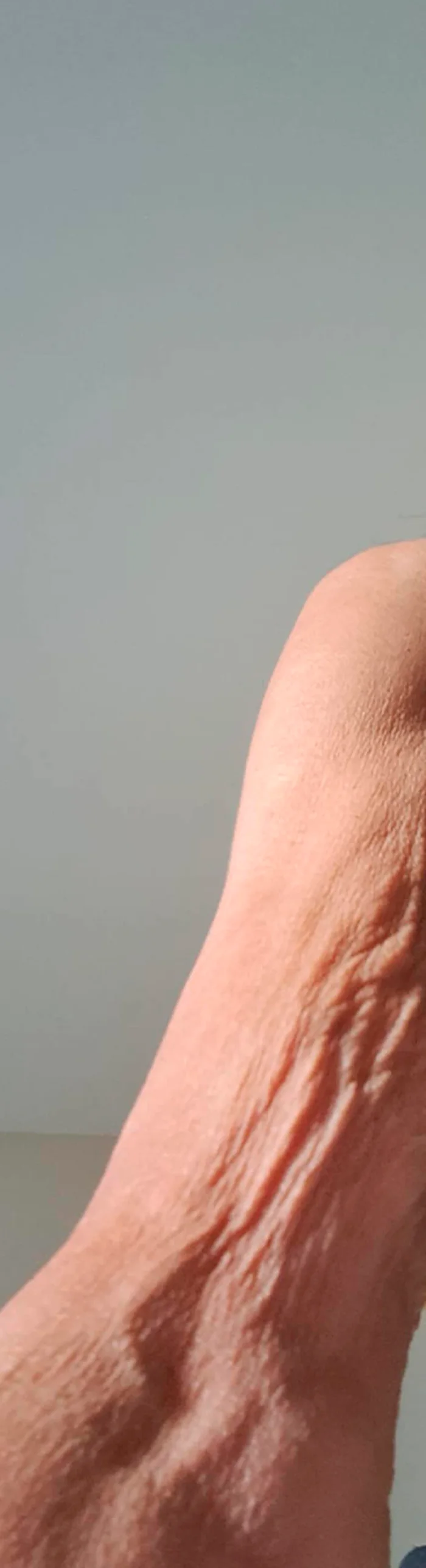 Flacidez en brazo, antes del tratamiento con Fibroblast