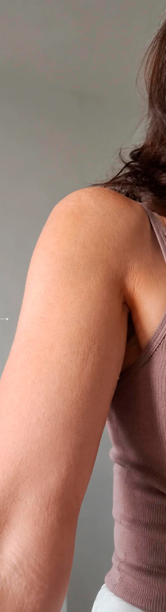 Flacidez en brazo, después del tratamiento con Fibroblast