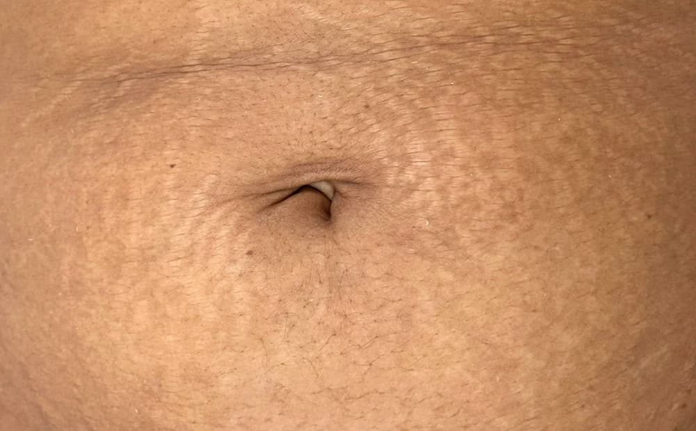 Estrías en abdomen, tratado con Micropuntura — antes