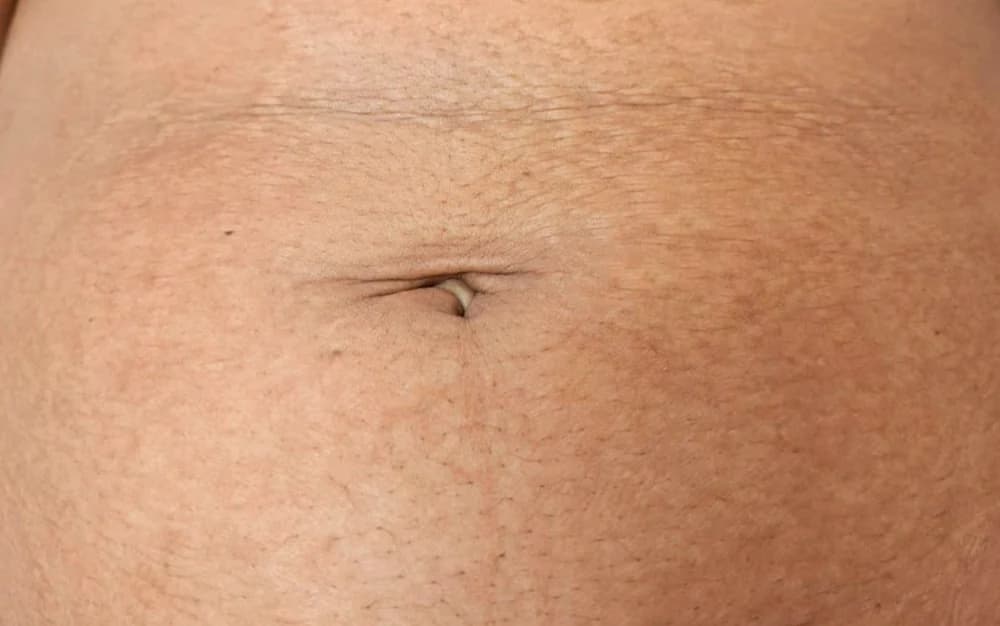 Estrías en abdomen, tratado con Micropuntura — después
