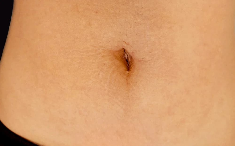 Estrías en abdomen, tratado con Micropuntura — antes