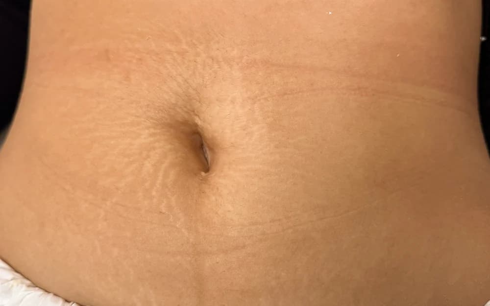 Estrías en abdomen, tratado con Micropuntura — después