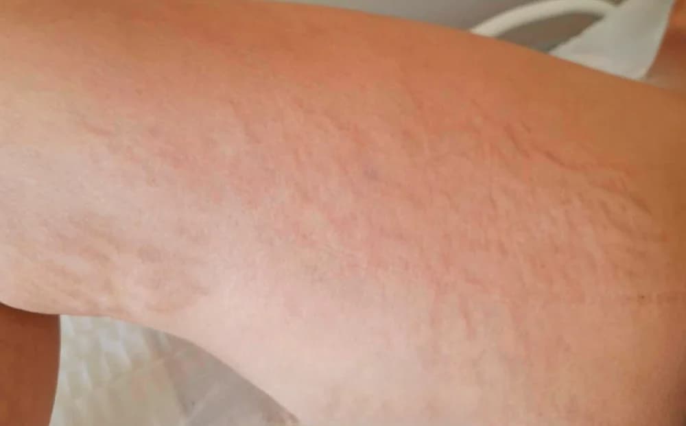 Estrías en brazo, tratado con Micropuntura — antes