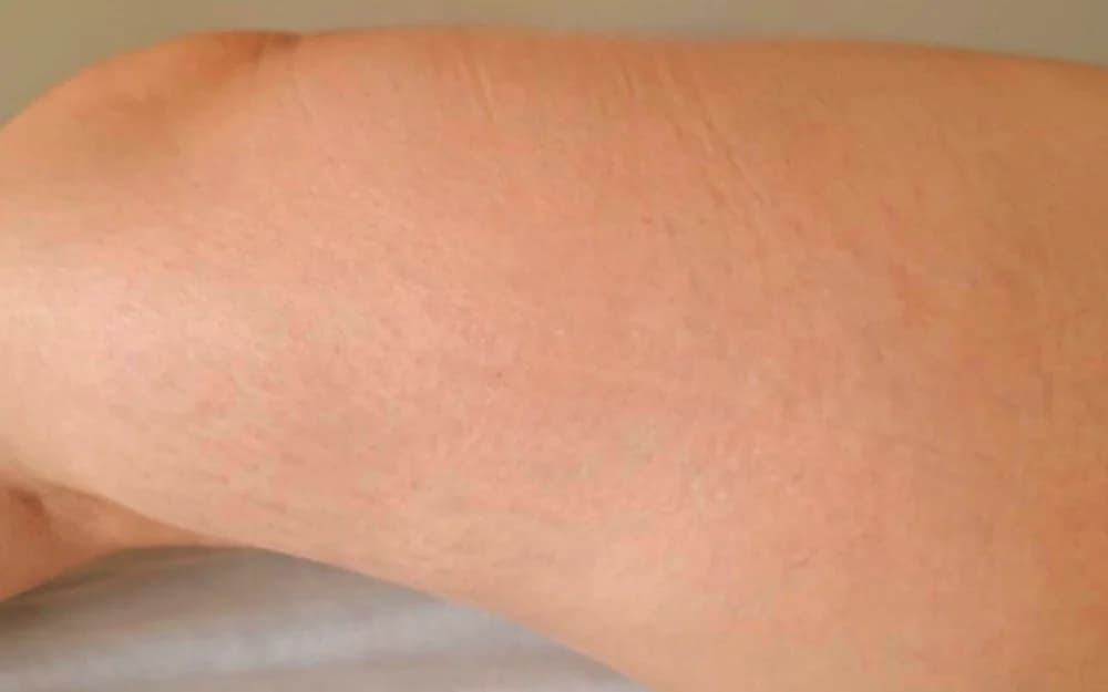 Estrías en brazo, tratado con Micropuntura — después
