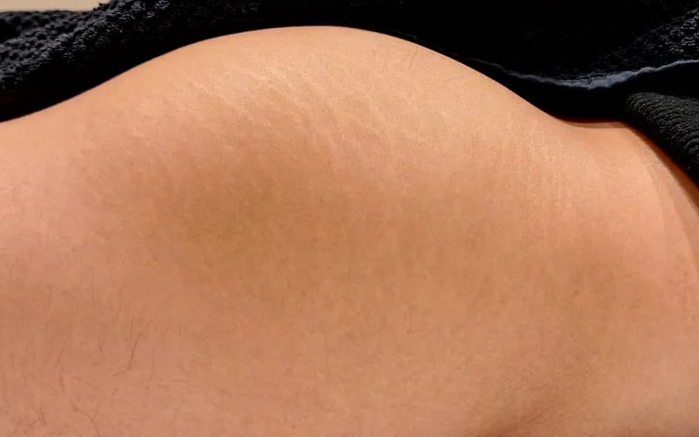 Estrías en glúteos, tratado con Micropuntura — después