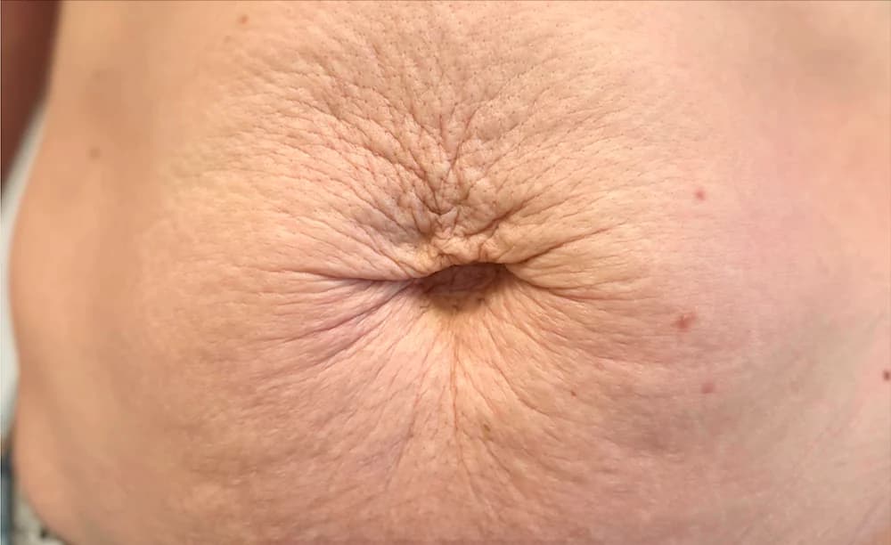 Flacidez abdominal, tratado con Fibroblast — antes