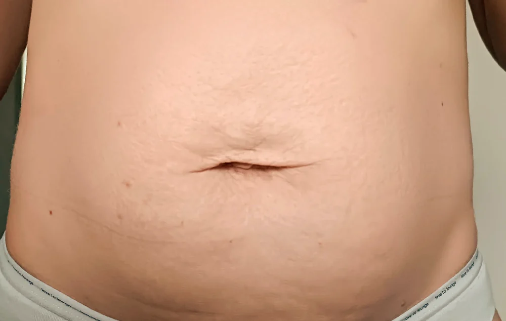 Flacidez abdominal, tratado con Fibroblast — después